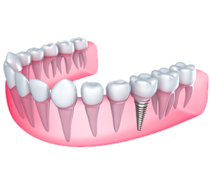 Renton Implant Dentistry